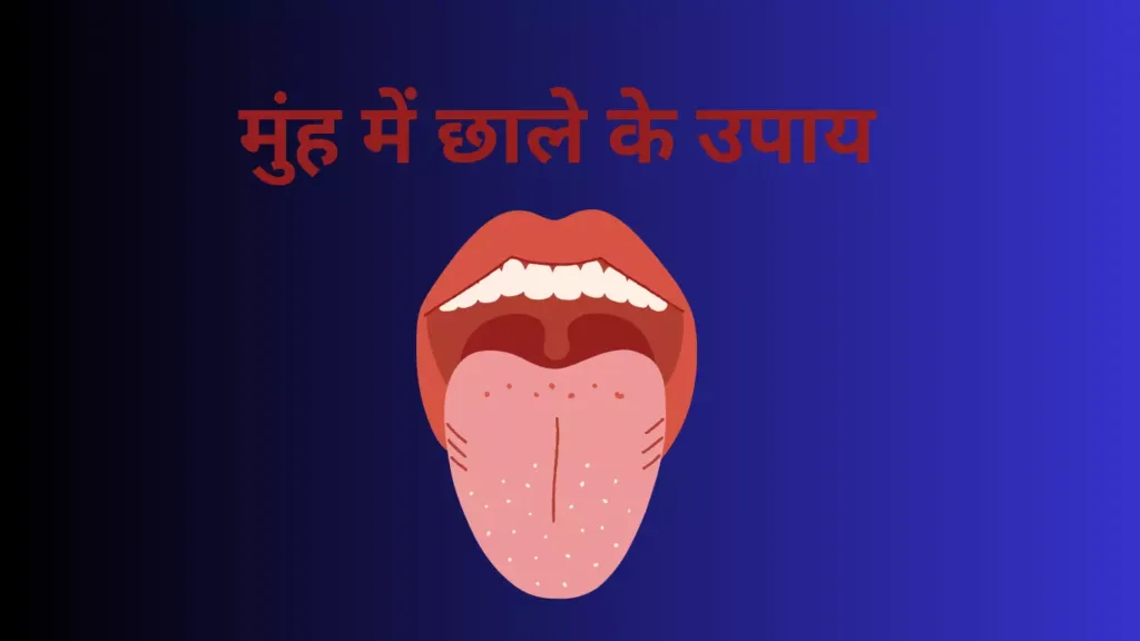 मुंह में छाले के उपाय